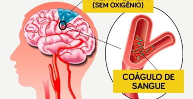 Accidente cerebrovascular isquémico: síntomas, causas y tratamiento