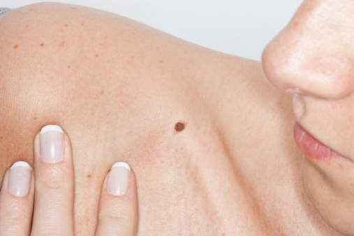 Imagen de autoexploración. Melanoma